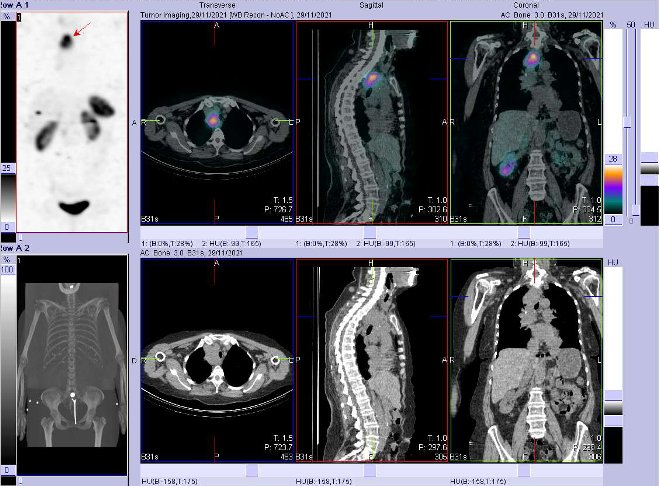 Obr. . 4: Fze obraz SPECT a CT. Zameno na loisko v mediastinu. Vyeten 4 hod. po aplikaci OctreoScanu.
