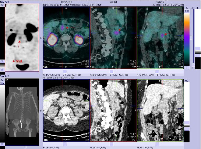Obr. . 8: Fze obraz SPECT a CT. Zameno na loisko vblzkosti pankreatu Vyeten 4 hod. po aplikaci OctreoScanu.