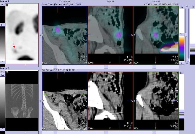 Obr. . 2: Fze SPECT/CT 4 hod. po aplikaci OctreoScanu. Zameno na loisko vpnvi vpravo.