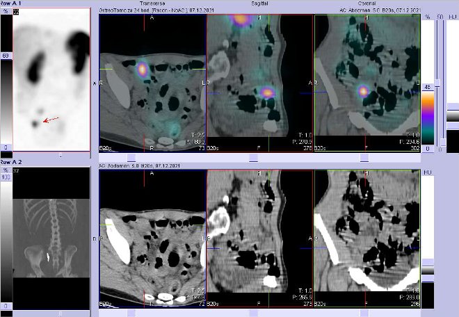 Obr. . 4: Fze obraz SPECT a CT. Zameno na loisko vpnvi vpravo. Vyeten 24 hod. po aplikaci OctreoScanu.