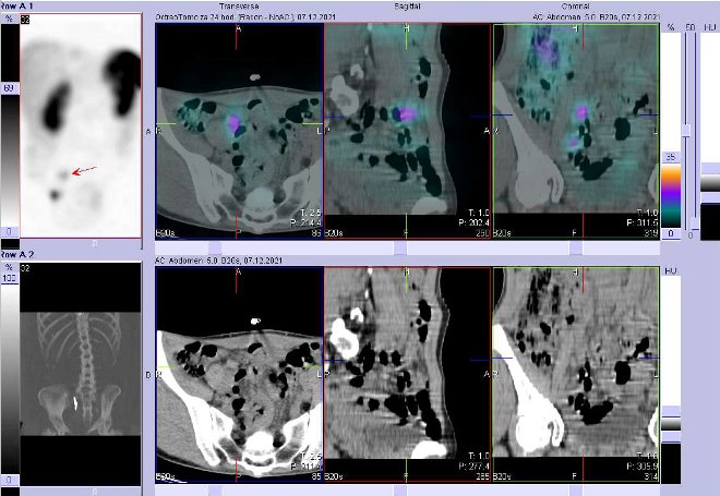 Obr. . 5: Fze obraz SPECT a CT. Zameno na loisko vpnvi vpravo. Vyeten 24 hod. po aplikaci OctreoScanu.