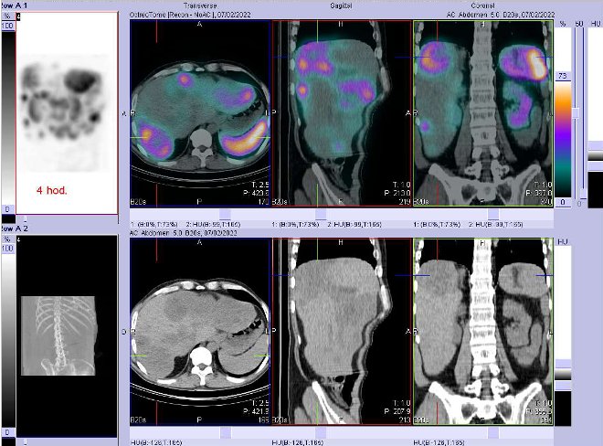 Obr. č. 3: Fúze obrazů SPECT a CT – vyšetření 4 hod. po aplikaci radiofarmaka. Zaměřeno na ložisko v pravém jaterním laloku.