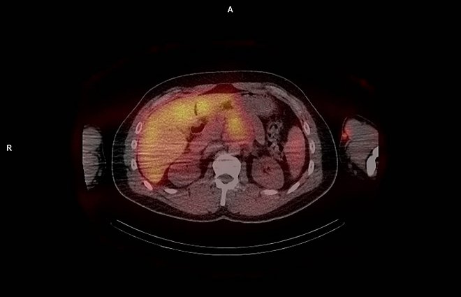 Obr.č.2: SPECT snímek břicha – ložisko retropankreaticky.