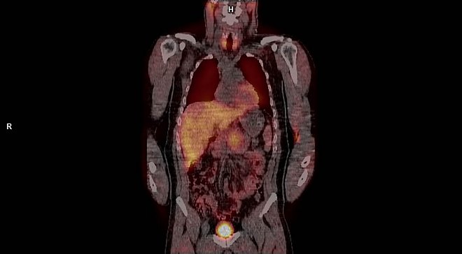 Obr. č. 4: SPECT snímek břicha – ložisko retropankreaticky.