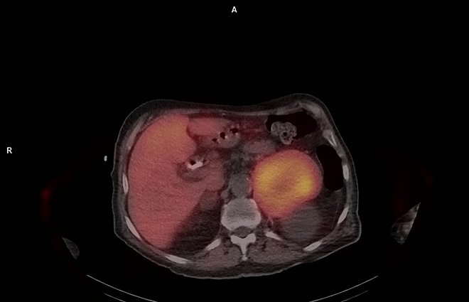 Obr.č.2: SPECT/CT snímek břicha.