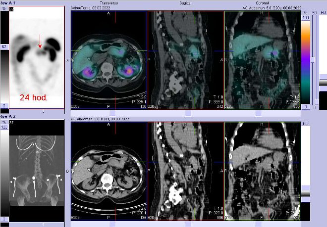 Obr. č. 6: Fúze obrazů SPECT a CT – vyšetření 24 hod. po aplikaci radiofarmaka. Zaměřeno na ložisko v pankreatu.