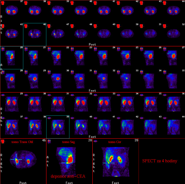 Obr. 2: Scintigrafie pomocí 99mTc CEA Scan metodou SPECT za 4 hodiny po aplikaci s následnou rekonstrukcí v rovině transversální,sagitální a koronální s patologickou ložiskovou depozicí radiofarmaka v pravém mesogastriu.