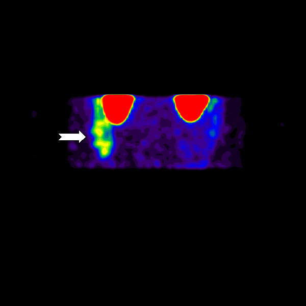 Obr. 6: Zobrazení patologické ložiskové depozice radiofarmaka v oblasti pravého mesogastria metodou maximum pixel raytrace v AP projekci(jiná barevná škála).