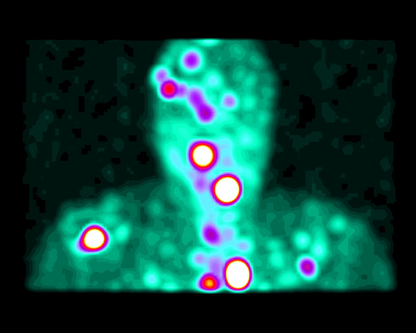 Obr. 4.: Zobrazení metodou maximum pixel raytrace-ložiskové depozice v kalvě,na basi lební,v mediastinu a v axillárních uzlinách