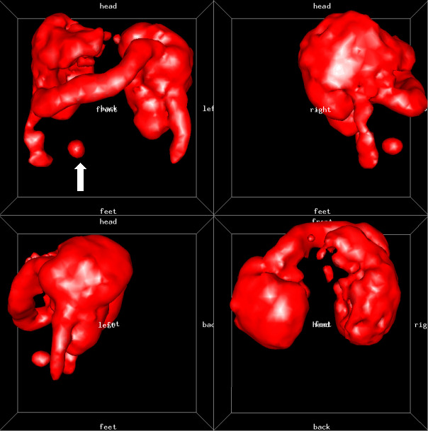 Obr. 4.: Zobrazení metodou 3D s fyziologickou akumulací v ledvinách, slezině, patologicky pak na rozhraní středního a pravého mesogastia