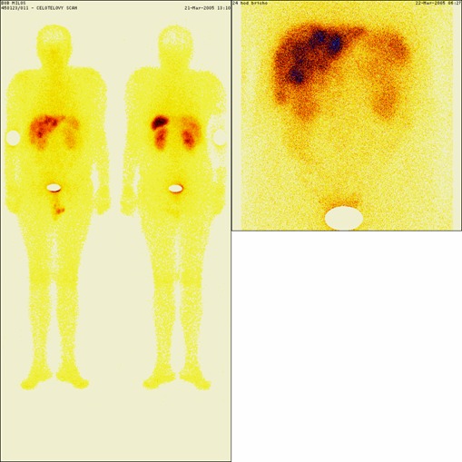 Obrzek .2: 111InOctreoScan - za 4 roky po operaci