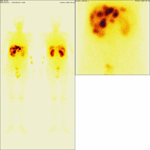 Obrzek .3: 111InOctreoScan - za 5 let po operaci