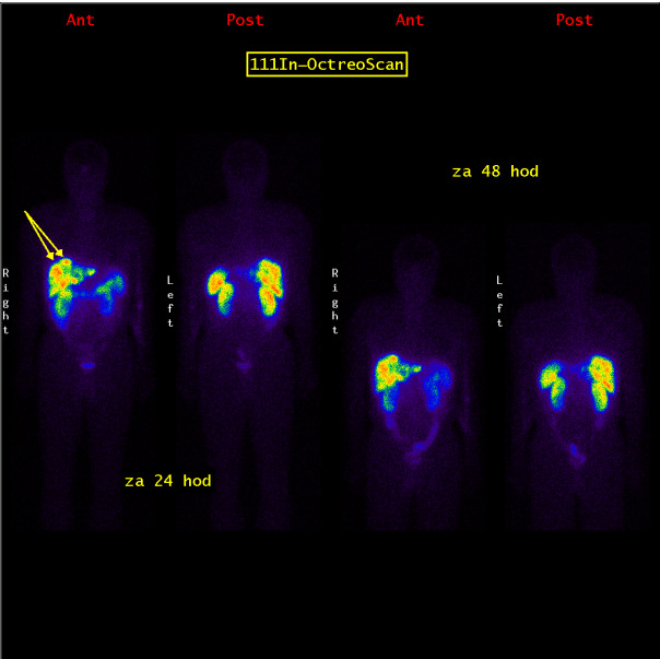 Obr.1.: Scintigrafie pomocí 111In-OctreoScan metodou „whole body“ za 24 a 48 hodin po aplikaci radiofarmaka s víčečetnými patologickými ložiskovými depozicemi radiofarmaka v oblasti jater.