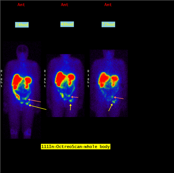 Obr.1.: Scintigrafie pomocí 111In-OctreoScan metodou „whole body“ za 24, 48 a 72 hodin po aplikaci radiofarmaka s patologickými ložiskovými depozicemi radiofarmaka v oblasti levého třísla a levé části pánve.