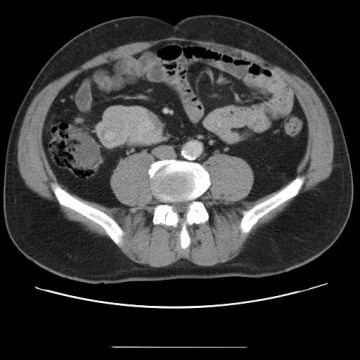 Obr.č.5: CT vyšetření břicha