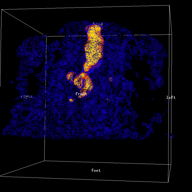 Obr. 1: 3D ve dvou prahovém zobrazení. AP pohled. Oranžově tumorózní masy, modře obrysy hrudníku.