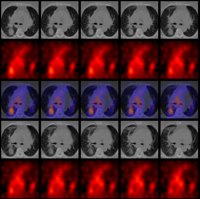 Obr. 6: Fúze obrazů, transverzální řezy. CT obraz v šedé škále, SPECT v červené škále, uprostřed fúzované obrazy.