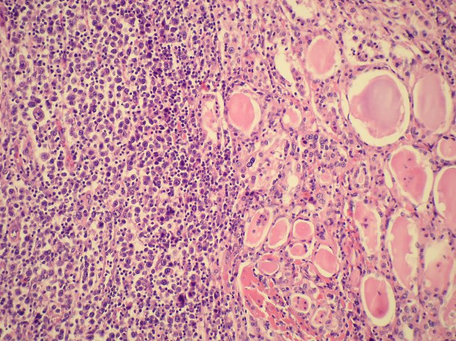 Obr. 10: Histologický řez – velkobuněčný karcinom plic pronikající do nitra štítné žlázy kolem folikulů naplněných koloidem. Barveno HE.