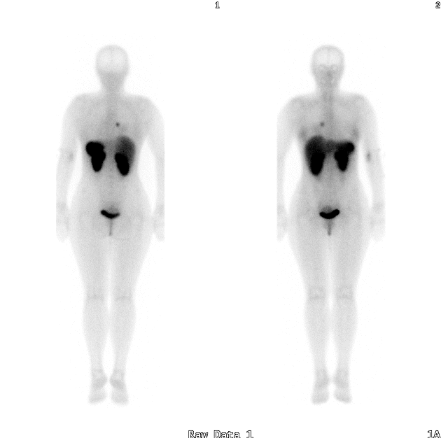 Obr.1: Celotlov scan. Jasn zobrazen patologick loisko v hrudnku.