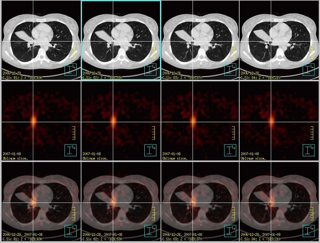 Obr.3: Fze obraz  transversln ezy. ed kla zvolena pro CT obrazy, erven kla pro SPECT, doln ada jsou fzovan obrazy. Kem oznaen tumor.
