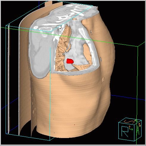 Obr.7: Fze v 3D obraze - vez v zobrazen transverslnm/koronrnm/sagitlnm. Tumor je zobrazen erven.