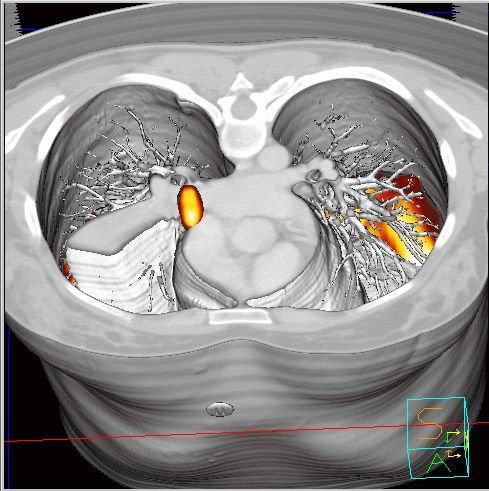 Obr.6: Fze v 3D obraze  transversln ez. Tumor (zobrazen ervenolut) nalhajc na stedn bronchus s atelektzou.