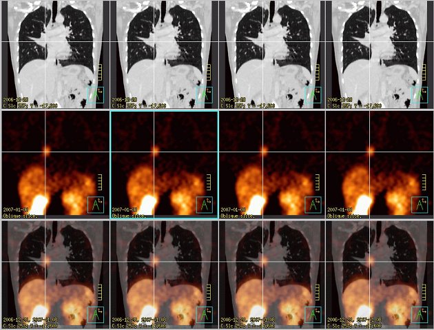 Obr.4: Fúze obrazů – koronární řezy. Šedá škála zvolena pro CT obrazy, červená škála pro SPECT, dolní řada jsou fúzované obrazy. Křížem označený tumor.