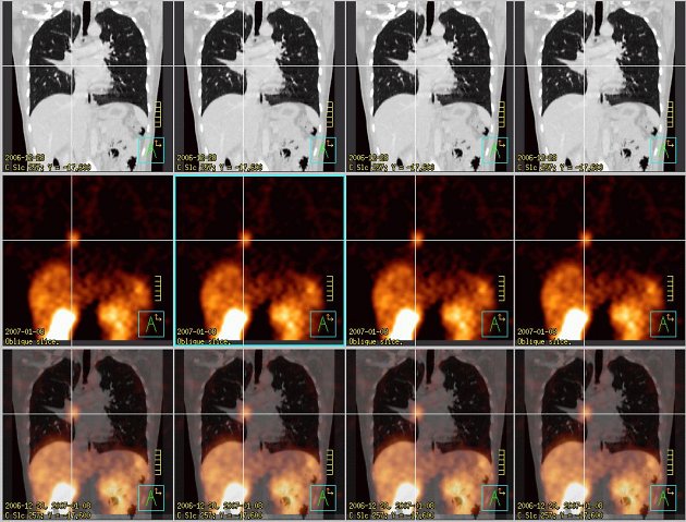 Obr.4: Fze obraz  koronrn ezy. ed kla zvolena pro CT obrazy, erven kla pro SPECT, doln ada jsou fzovan obrazy. Kem oznaen tumor.
