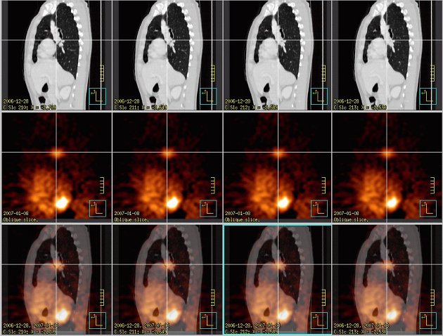 Obr.5: Fze obraz  sagitln ezy. ed kla zvolena pro CT obrazy, erven kla pro SPECT, doln ada jsou fzovan obrazy. Kem oznaen tumor.