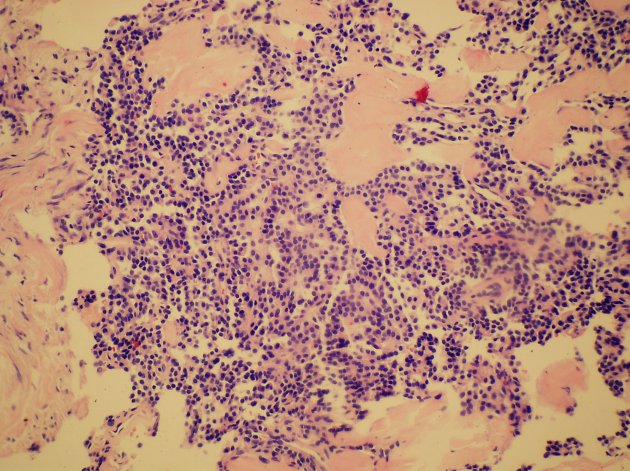 Obr.8: Histologick ez dobe diferencovanho neuroendokrinnho karcinomu. Barven HE.