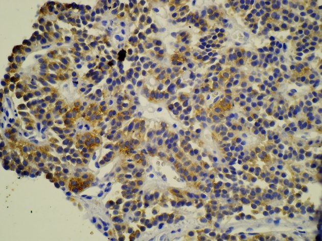 Obr.9: Histologick ez dobe diferencovanho neuroendokrinnho karcinomu. Barven na neuron specifickou enolzu (NSE).