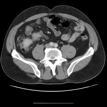 Obr.č.3: CT vyšetření břicha