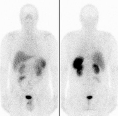 Obr..4: Celotlov scintigrafie v pedn a zadn projekci 5 hod. po aplikaci OctreoScanu