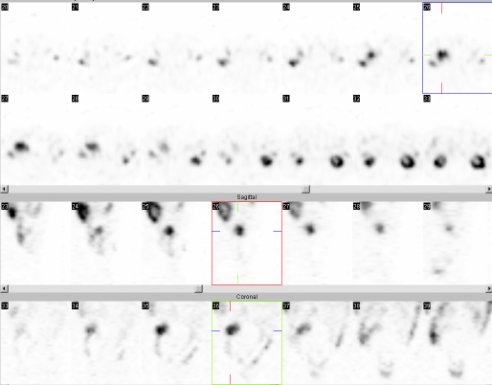 Obr..5: SPECT bicha 5 hod. po aplikaci OctreoScanu Horn 2 ady: transverzln ezy, Tet ada: sagitln ezy, doln ada: koronln ezy