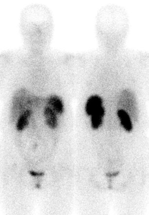 Obr. . 1: Celotlov scintigrafie v pedn a zadn projekci 5 hod. po aplikaci OctreoScanu