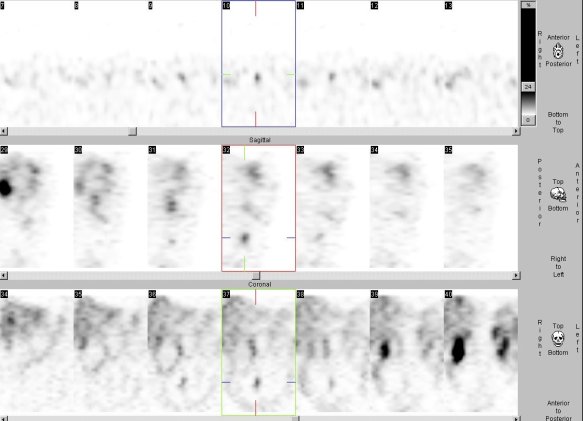 Obr. č. 5: Tomografická scintigrafie břicha a pánve 24 hod. po aplikaci OctreoScanu. Zaměřeno na oválné ložisko na rozhraní dolní a střední třetiny břicha těsně vpravo od střední čáry
