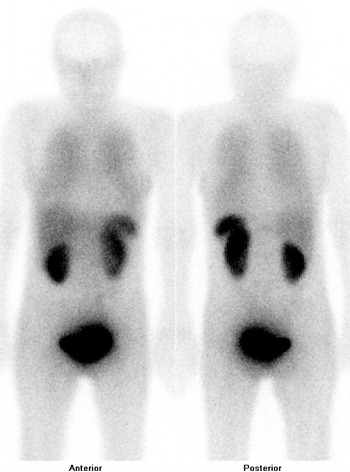 Obr..1: Celotlov scintigrafie v pedn a zadn projekci 5 hod. po aplikaci OctreoScanu