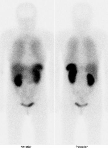 Obr..2: Celotlov scintigrafie v pedn a zadn projekci 24 hod. po aplikaci OctreoScanu