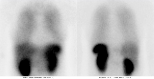 Obr..3: Statick scintigrafie v pedn a zadn projekci 24 hod. po aplikaci OctreoScanu