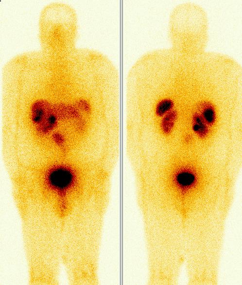Obr. 1. Celotelov scintigrafie, zadn a predn projekce, 4 hodiny po i.v. aplikaci radiofarmaka