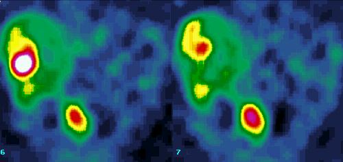 Obr. 4.SPECT, koronrn rez. Zbytkov tumor v retroperitoneu + metastzy v jtrech