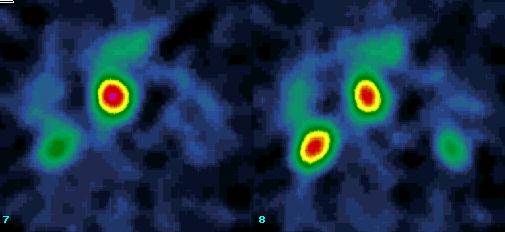 Obr.5. SPECT, transversln rez. Zbytkov tumor v retroperitoneu v mezogastriu