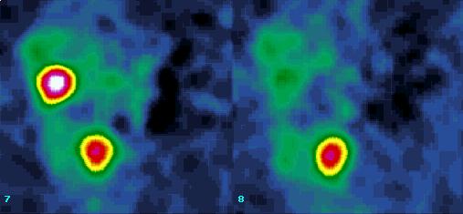 Obr. 8 SPECT, sagitln rez. Zbytkov tumor v retroperitoneu + metastza v jtrech