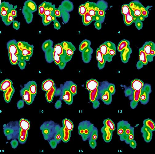 Obr. 9 SPECT, 3D rekonstrukce