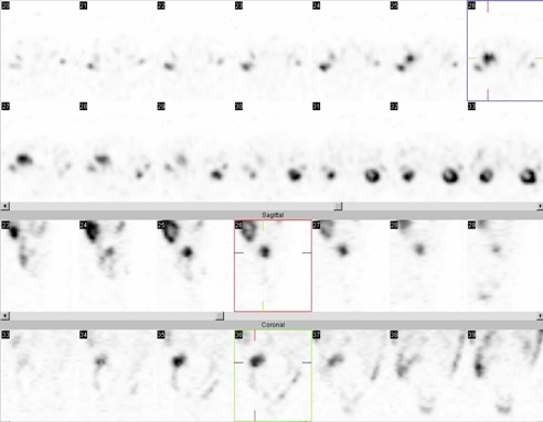 Obr..2: SPECT bicha 5 hod. po aplikaci OctreoScanu