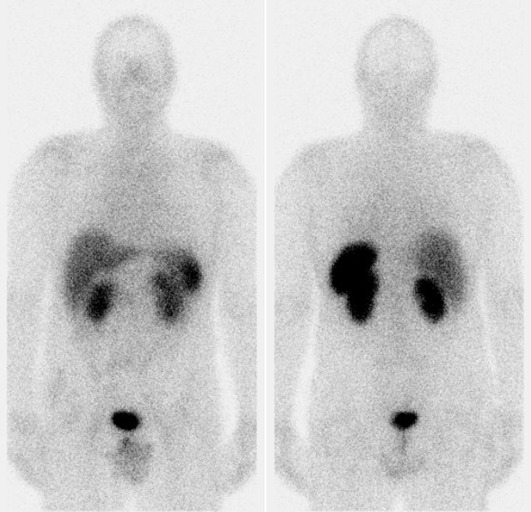 Obr..4: Celotlov scintigrafie v pedn a zadn projekci 5 hod. po aplikaci OctreoScanu