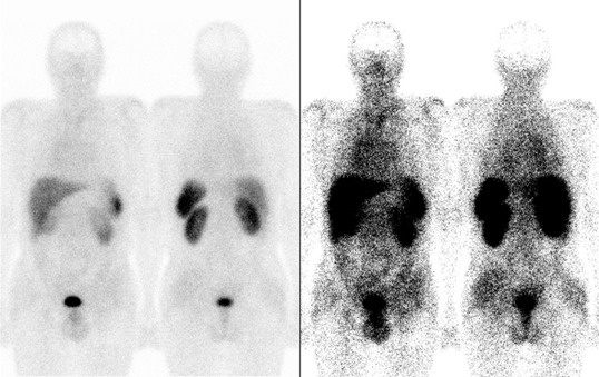 Obr..1: Celotlov scintigrafie v pedn a zadn projekci 5 hod. po aplikaci OctreoScanu