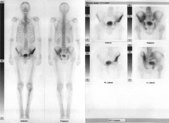 Obr. . 2: Celotlov scintigrafie skeletu v pedn a zadn projekci a statick scintigramy pnve