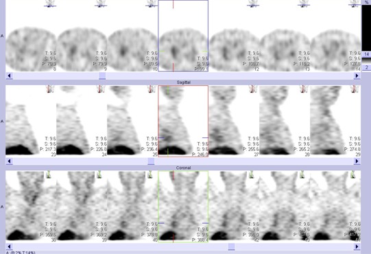 Obr..2: Tomografick scintigrafie hrudnku 5 hod. po aplikaci OctreoScanu