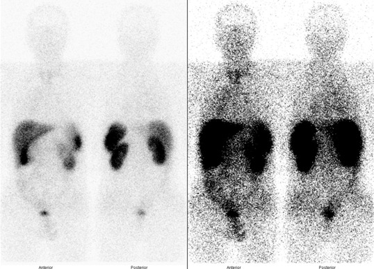 Obr..3: Celotlov scintigrafie v pedn a zadn projekci 24 hod. po aplikaci OctreoScanu